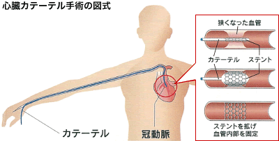 心臓カテーテル治療