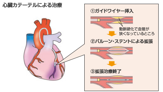 心臓カテーテル治療
